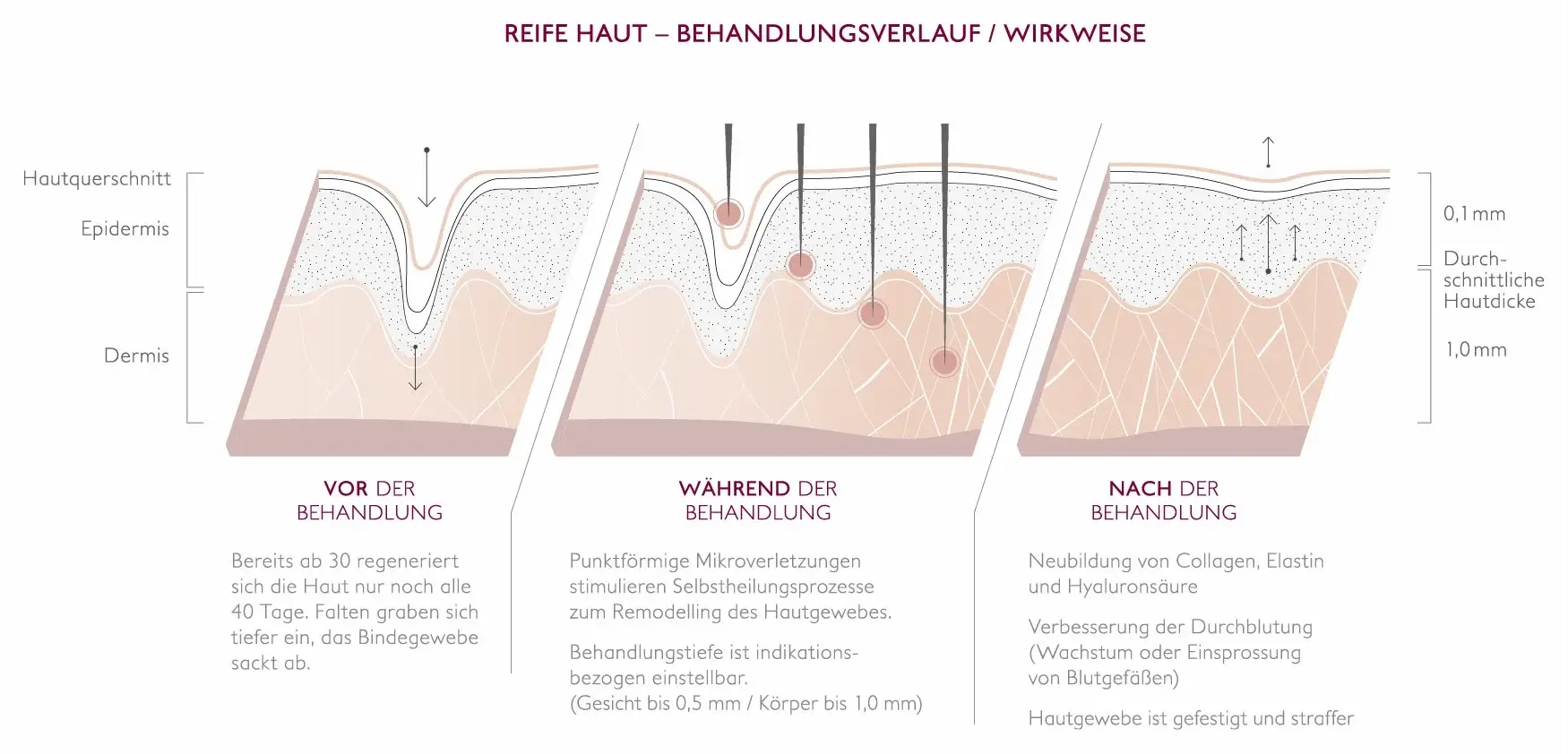 Hautquerschnitt in drei Schritten: vor, während und nach der Needling-Behandlung reifer Haut — Mikroverletzungen stimulieren die Neubildung von Collagen, Elastin und Hyaluronsäure