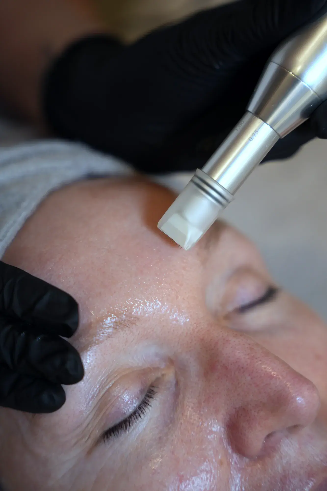 Microneedling im House of Shido