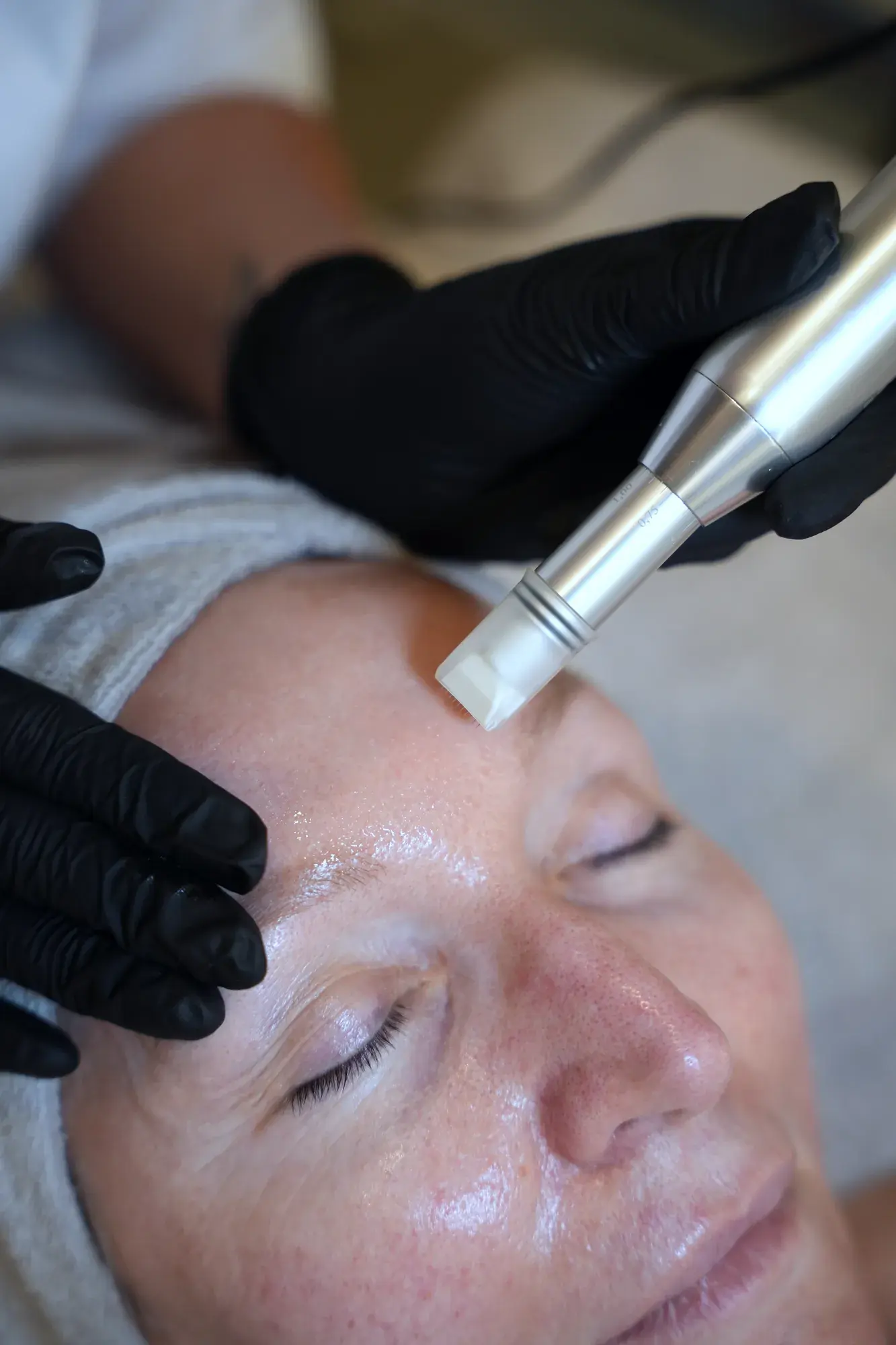 Microneedling im House of Shido